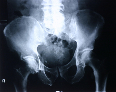Higher dose vitamin D reduces fractures by 20% in over 65s 669bdc341e4d5.jpeg