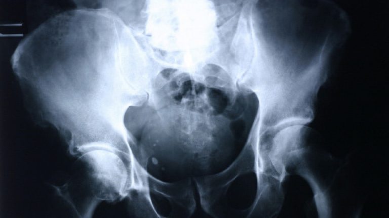 Higher dose vitamin D reduces fractures by 20% in over 65s_669bdc341e4d5.jpeg